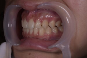 前歯の隙間(正中離開)および叢生をマウスピース矯正で改善した治療後の側方面口腔内写真