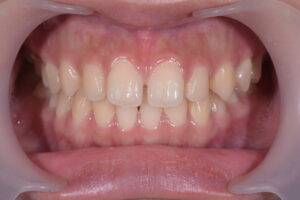 前歯の隙間(正中離開)と歯列不正を伴う症例の術前口腔内写真