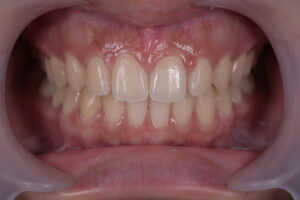 前歯の隙間(正中離開)および歯列不正をマウスピース矯正で改善した治療後の口腔内写真