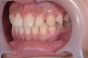 前歯の隙間(正中離開)と叢生を伴う歯列不正の術前左側方面口腔内写真