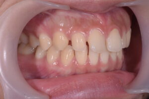 前歯の隙間(正中離開)と叢生を伴う歯列不正の術前側方面口腔内写真