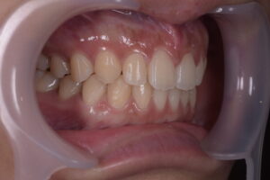 前歯の隙間(正中離開)および叢生をマウスピース矯正で改善した治療後の右側方面口腔内写真