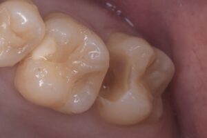 名古屋市北区 歯科 虫歯治療 術前