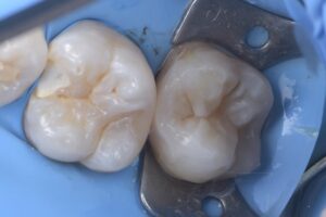 名古屋市北区 ダイレクトボンディング ラバーダム