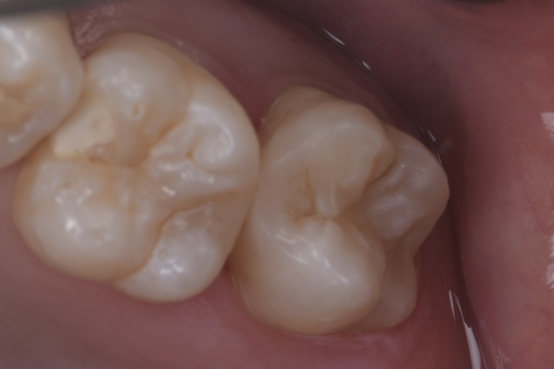 名古屋市北区 歯科 虫歯治療 ダイレクトボンディング
