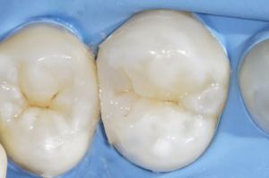 ダイレクトボンディングによる上顎第一小臼歯むし歯治療直後の状態