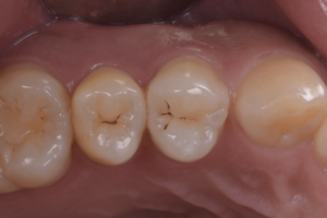 ダイレクトボンディング治療後数年経過した小臼歯の状態