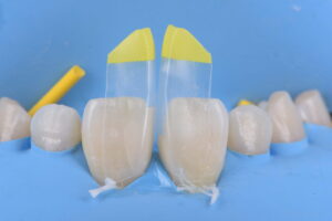 ラバーダム防湿下で行う正中離開のダイレクトボンディング治療