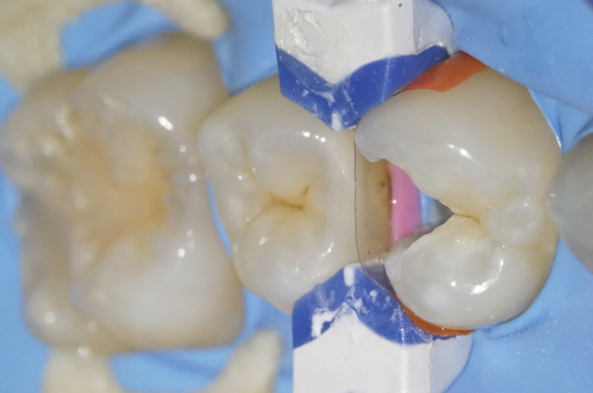 上顎第一小臼歯のむし歯をラバーダム防湿下でダイレクトボンディング治療している様子