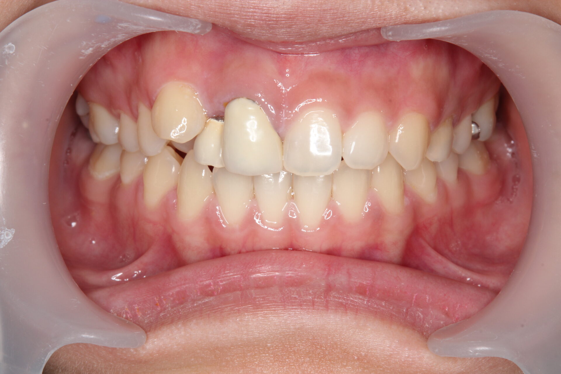 前歯部に不良補綴（変色したクラウン）と叢生を認める審美不良症例の術前口腔内写真