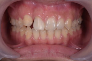 抜歯後のスペースをマウスピース矯正により閉鎖している治療途中の口腔内写真