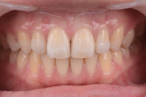ダイレクトボンディングで改善した前歯のすきっ歯（正中離開）