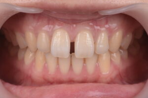前歯のすきっ歯（正中離開）の治療前口腔内写真
