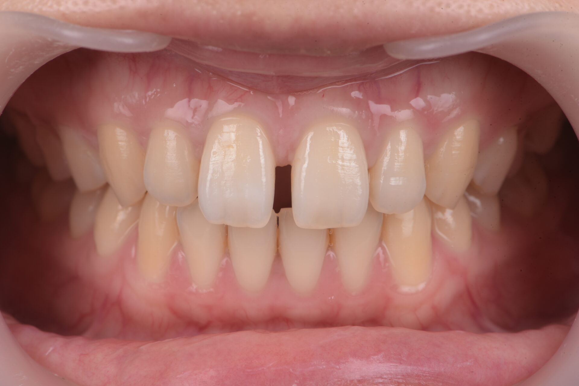前歯のすきっ歯（正中離開）の治療前口腔内写真
